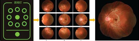 Diseases Digital Retinal Imaging Can Help Detect Sooner Fundus