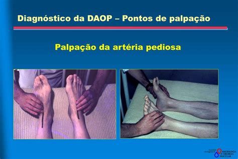 Ppt Doença Arterial Obstrutiva Periférica Daop Powerpoint