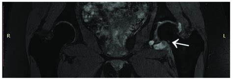 First MRI scan of the hip joints with visible focus of OO (arrow) in ...