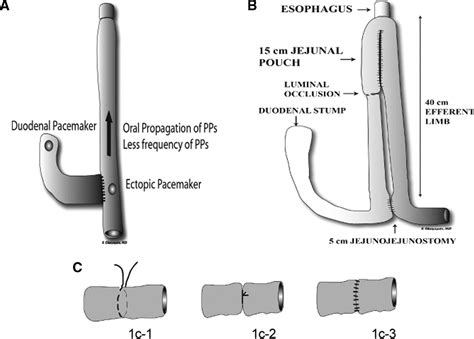 The Uncut Roux En Y With Jejunal Pouch A New Reconstruction Technique