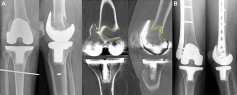 New Classification For Periprosthetic Distal Femoral Fractures Based On Locked Plate Fixation