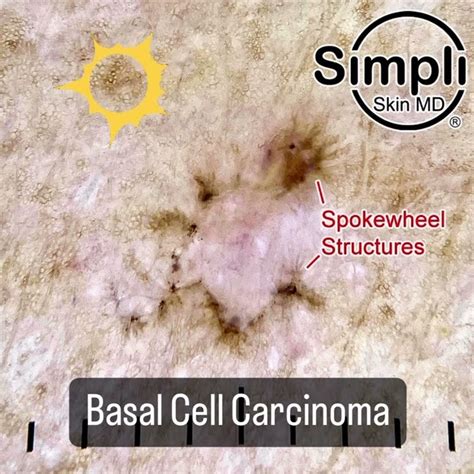 Basal Cell Carcinoma Dermoscopy Youtube