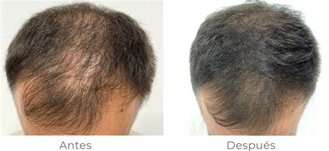 Alopecia Androgénica Ana Morell Dermatología Clínica Y Cirugía