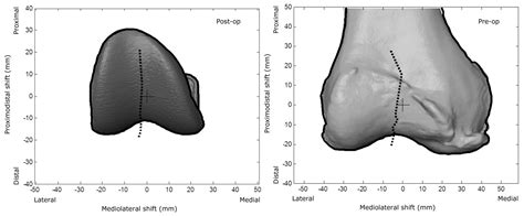 Radiological Method For Measuring Patellofemoral Tracking And