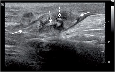 Scielo Brasil Suture Granuloma After Orchiectomy Sonography