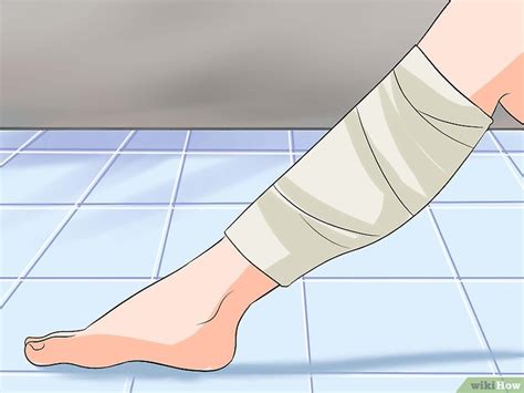 Cómo curar un hematoma 10 Pasos con imágenes wikiHow