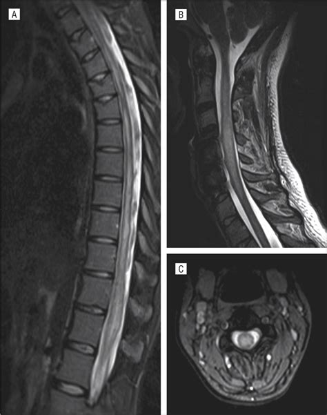 Longitudinally Extensive Transverse Myelitis Following Vaccination With Nasal Attenuated Novel