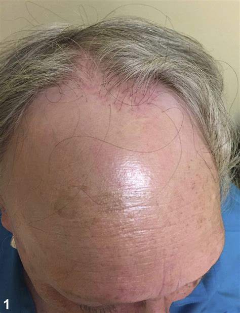 Perifollicular Erythematous Papules On The Scalp Journal Of The