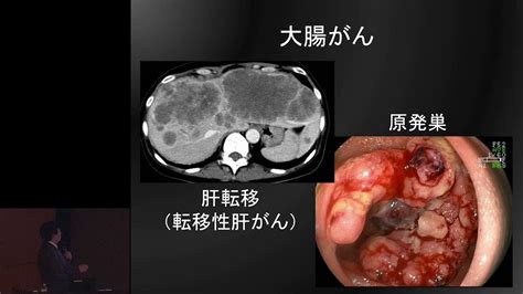 大腸がんの抗がん剤治療～いまとこれから～ 山口 研成 Youtube