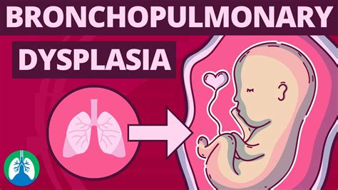 Bronchopulmonary Dysplasia Bpd Medical Definition And Explainer