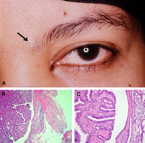 Hidradenoma Papilliferum Causes Symptoms Diagnosis Treatment