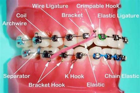 What Is An Orthodontic Bracket On Dental Braces ArchWired