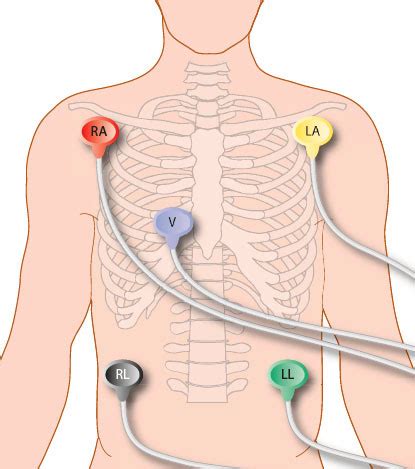 Ecg Monitor Lead Placement