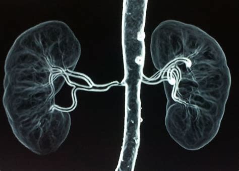 Renal Artery Stenosis - Causes, Symptoms & Treatment Options