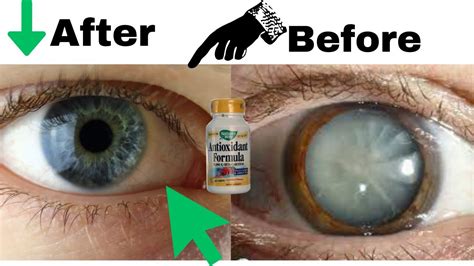 The Remedy For Cataracts Best Natural Remedy To Cure Cataracts