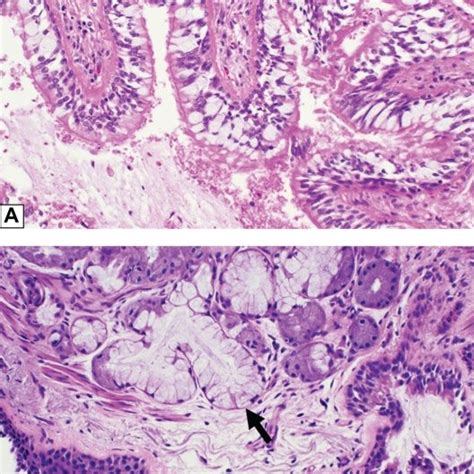 Histologic Features Of Centrilobular Emphysema A Section Of Lung