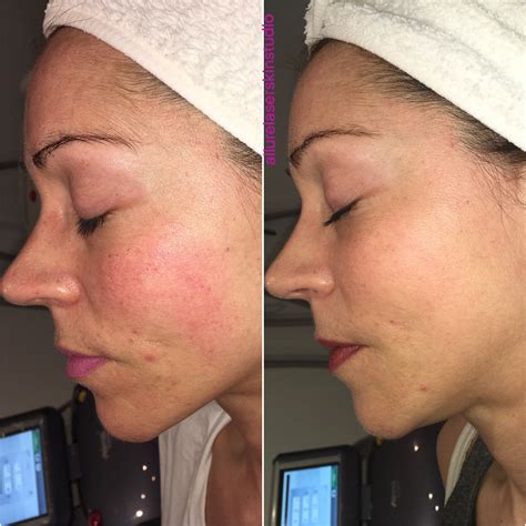 AFT LASER TREATMENTS ALLURE LASER SKIN STUDIO