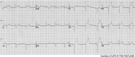 Acute Myocardial Infarction A Shifting Paradigm Recapem