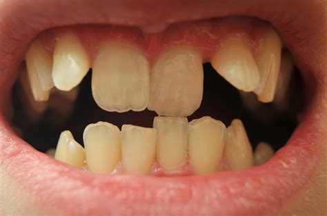 Bottom Teeth Uneven At Jennifer Hubbard Blog