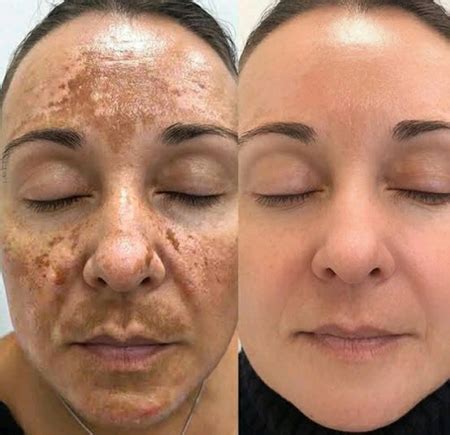 Clareamento Melasma