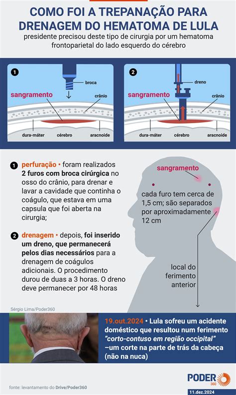 Entenda Como Ser O Novo Procedimento Na Cabe A De Lula