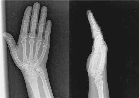 Figure From Lunate Excision With Capitohamate Fusion In The Treatment