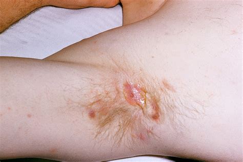 Hidradenitis Suppurativa Hs Wetenschap