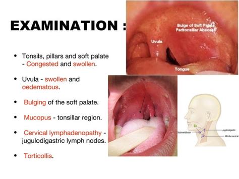 Quinsy Peritonsillar Abscess