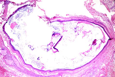 [figure Epidermoid Cyst Hande Staining At 40x Magnification