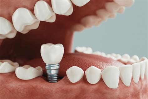 Implantes dentales precios 2024 Cuánto cuesta en Argentina