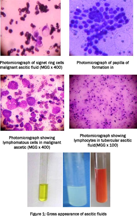 Figure 1 From Analysis Of Ascetic Fluid For Cytological And Biochemical Findingsx Semantic Scholar