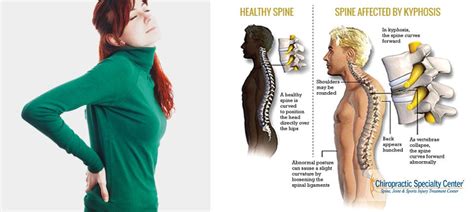 Kyphosis Of The Spine And How It Differs From Scoliosis?