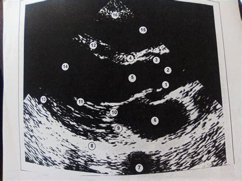 Parasternal long axis view Diagram | Quizlet