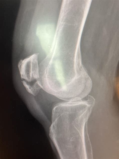 Patellar fracture : r/XRayPorn