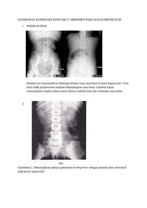 Gambaran Radiologi Ileus Compress Gambaran Radiologi Foto Akut