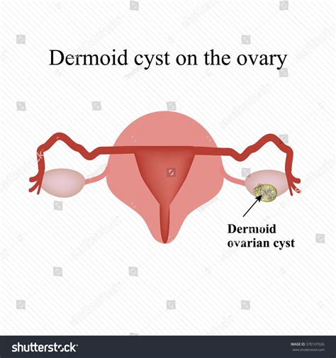 Dermoid Cyst On Ovary Ovary Infographics Vetor Stock Livre De