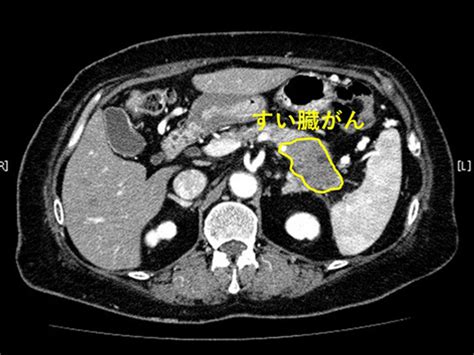 すい臓がんの症例写真と解説 夙川内視鏡内科まえだクリニック（西宮市で痛くない胃カメラ・下剤を飲まない大腸カメラを土曜日曜も実施）