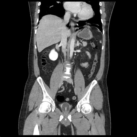 File Bowel Ischemia Mesenteric Arterial Vascular Occlusion