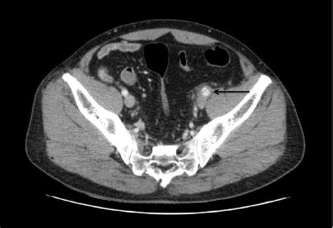 Figure 1 From A Case Of Spontaneous Common Iliac Atery Dissection Semantic Scholar