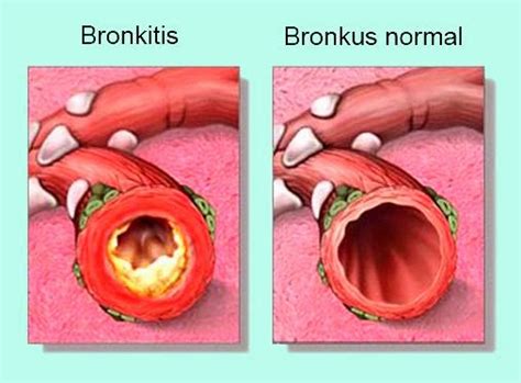 Penyebab Gejala Penyakit Bronkitis Akut Bronkitis Kronis Dan