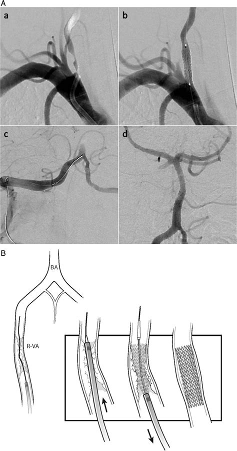 Endovascular Reconstruction Of Vertebral Artery Occlusion Prior To