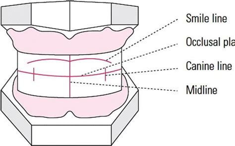 Recording A Bite Registration For The Edentulous Patient Medimatch