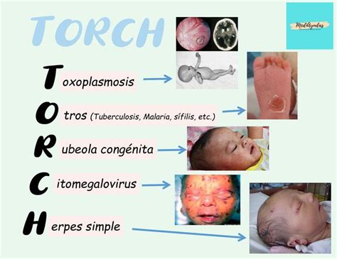 TORCH PEDIATRIA MediAyudas UDocz