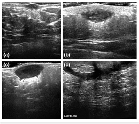 Ultrasound Showing The Types Of Hs Lesions A Superficial Nodule B Download Scientific