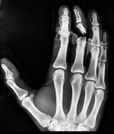 Middle phalanx open fracture | Radiology Case | Radiopaedia.org