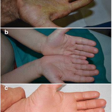 Palmar Involvement In Arci Severe Keratoderma In Patient Id With