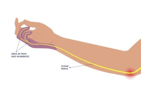 Ulnar Nerve Entrapment At The Elbow Cubital Tunnel Syndrome Ulnar