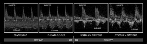 Simultaneous Venous Arterial Doppler Ultrasound During Early Fluid Resuscitation To Characterize