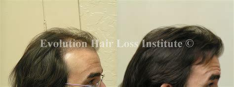 Before and After Hair Growth Treatment Photos