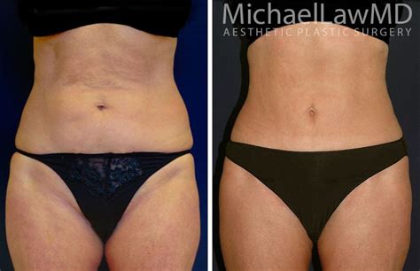 Reverse Upper Modified Lower Abdominoplasty Photo Gallery Page Of